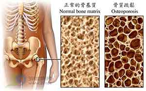 正常探花视频在线与骨质疏松的探花视频在线