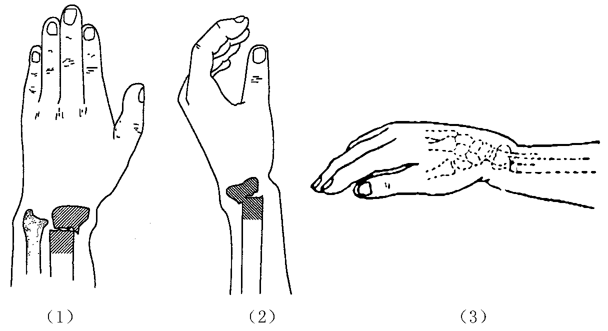 超声探花视频在线仪临床研究发生桡骨远端骨折怎么办？