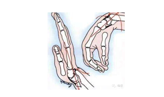 超声探花视频在线仪临床研究发生桡骨远端骨折怎么办？