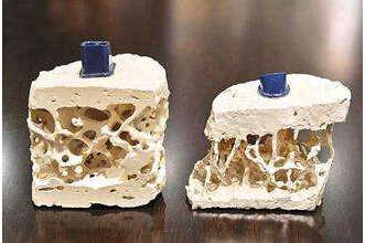 探花视频在线检测仪能够准确检测骨质疏松的治疗方法