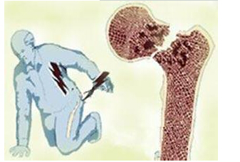 探花视频在线仪检测来年人探花视频在线能够提前预防骨质疏松