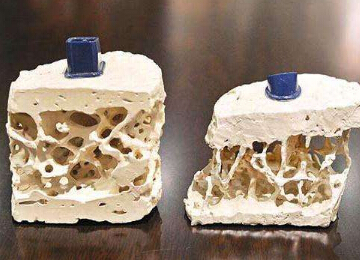 探花视频在线仪提示骨质疏松并非是老年人的“专利”五宜五忌不要掉以轻心