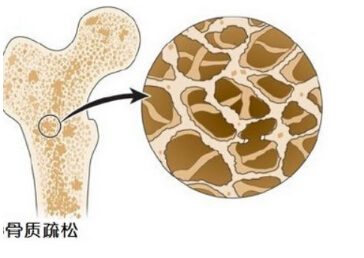 探花视频在线仪提示骨质疏松并非是老年人的“专利”五宜五忌不要掉以轻心