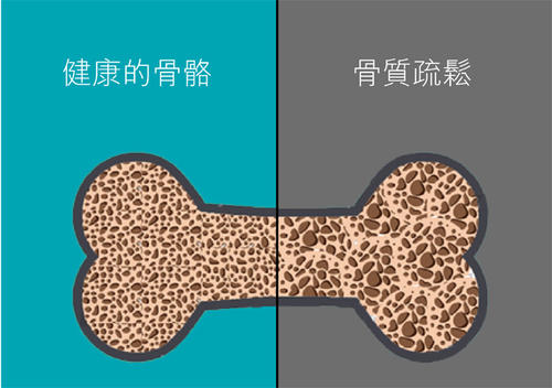 老年人骨质疏松易导致骨折之超声探花视频在线检查仪的临床价值是什么？