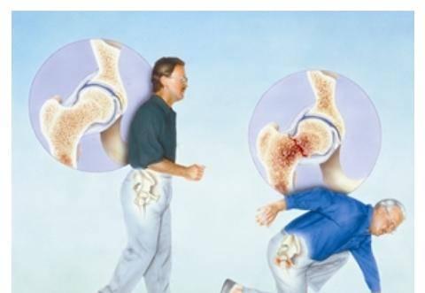 贵州超声探花视频在线分析仪品牌哪些人需要进行探花视频在线测试骨质疏松症