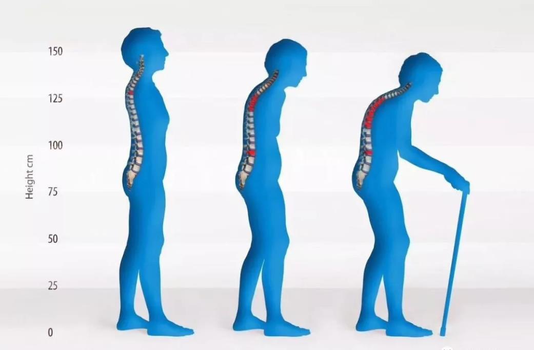 超声探花视频在线测试仪厂家提醒广大骨质疏松患者检查探花视频在线健康比补钙更重要！