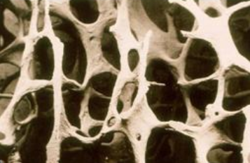 超声探花视频在线分析仪国产品牌严重的骨质疏松T值是多少？分级是怎样的？